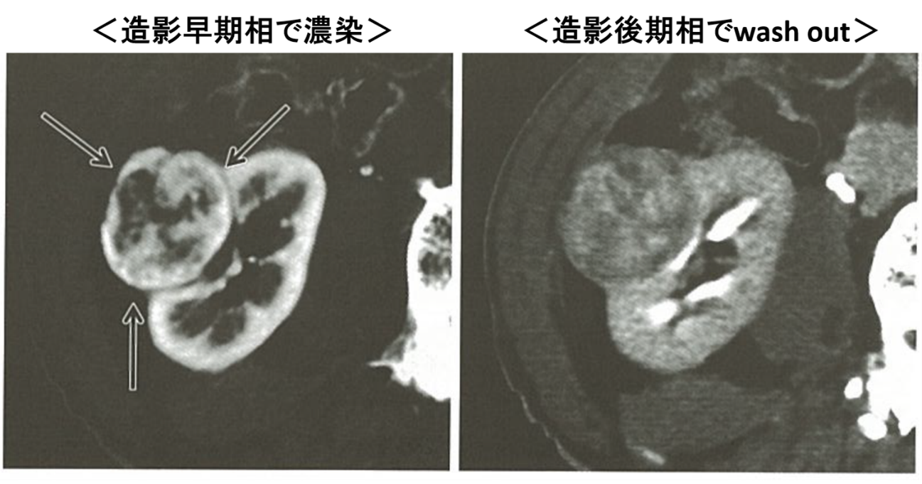 造影CT画像例