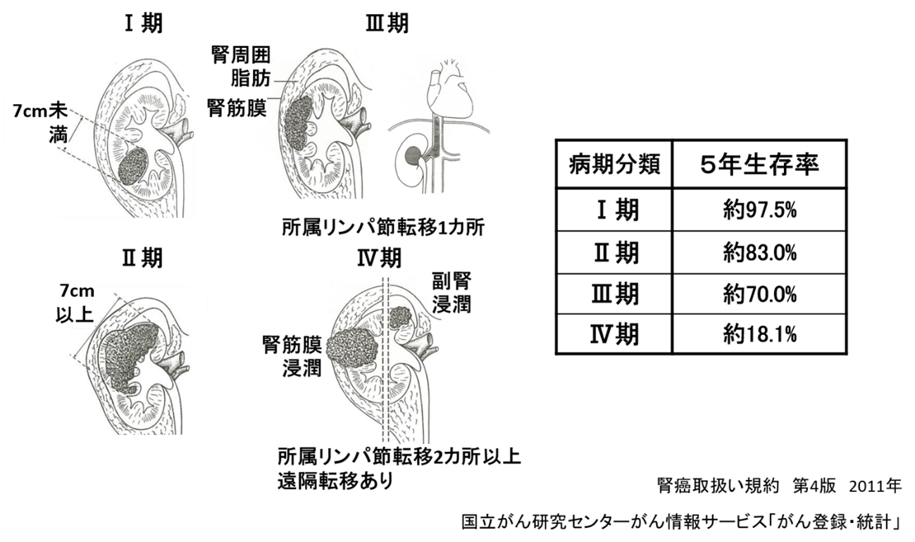 病期分類と予後