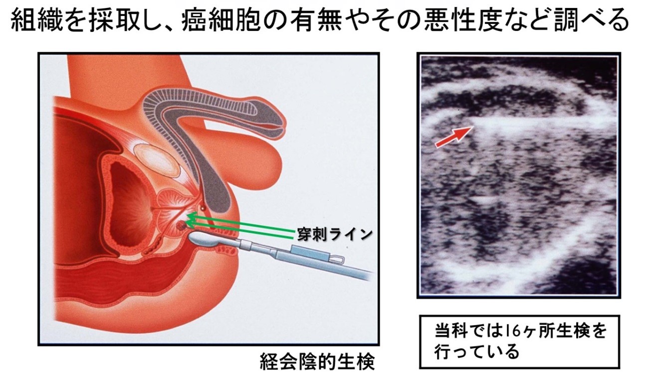 前立腺針生検