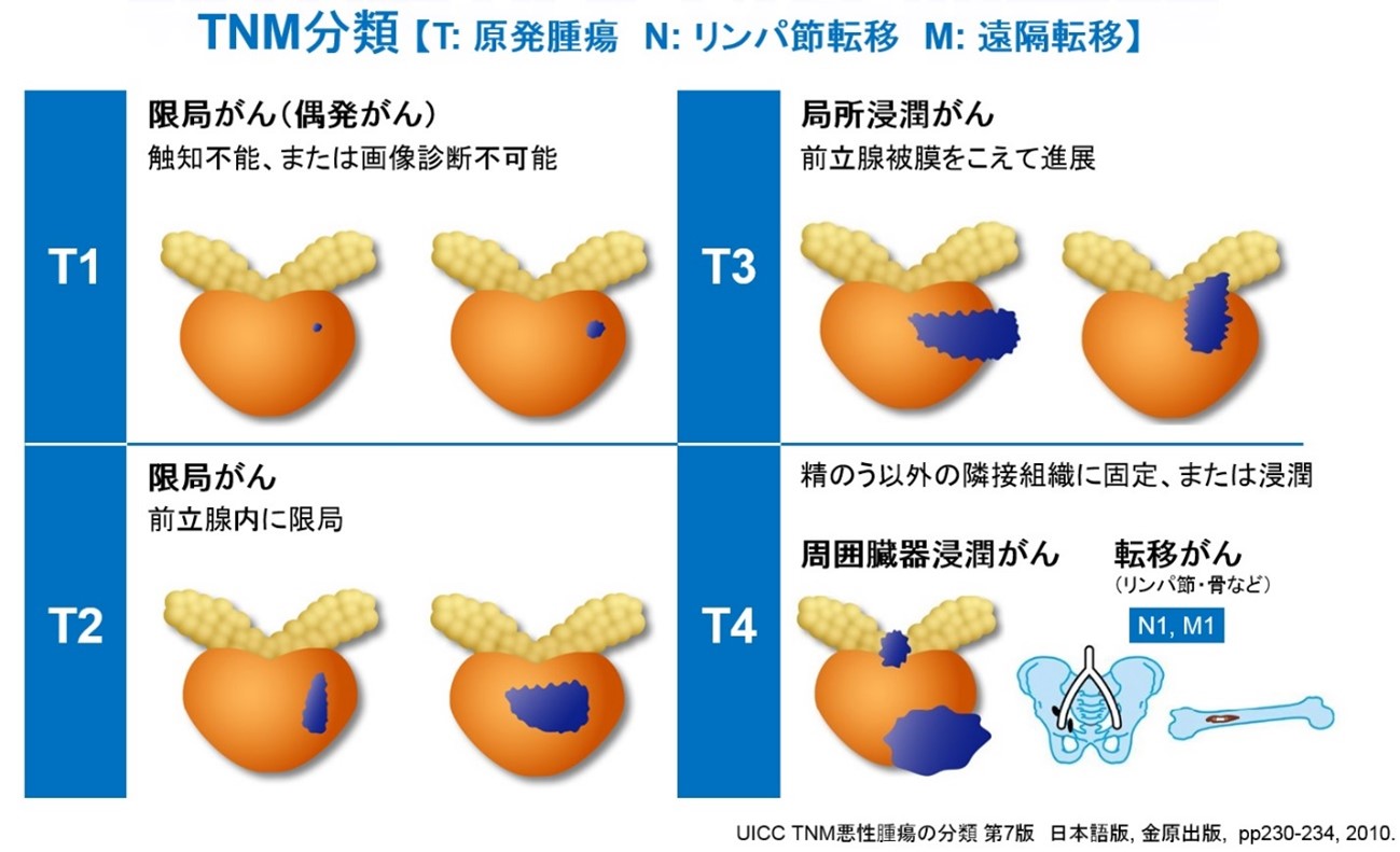 TNM分類