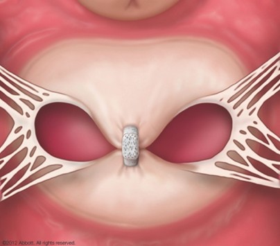 植え込み型ループレコーダー