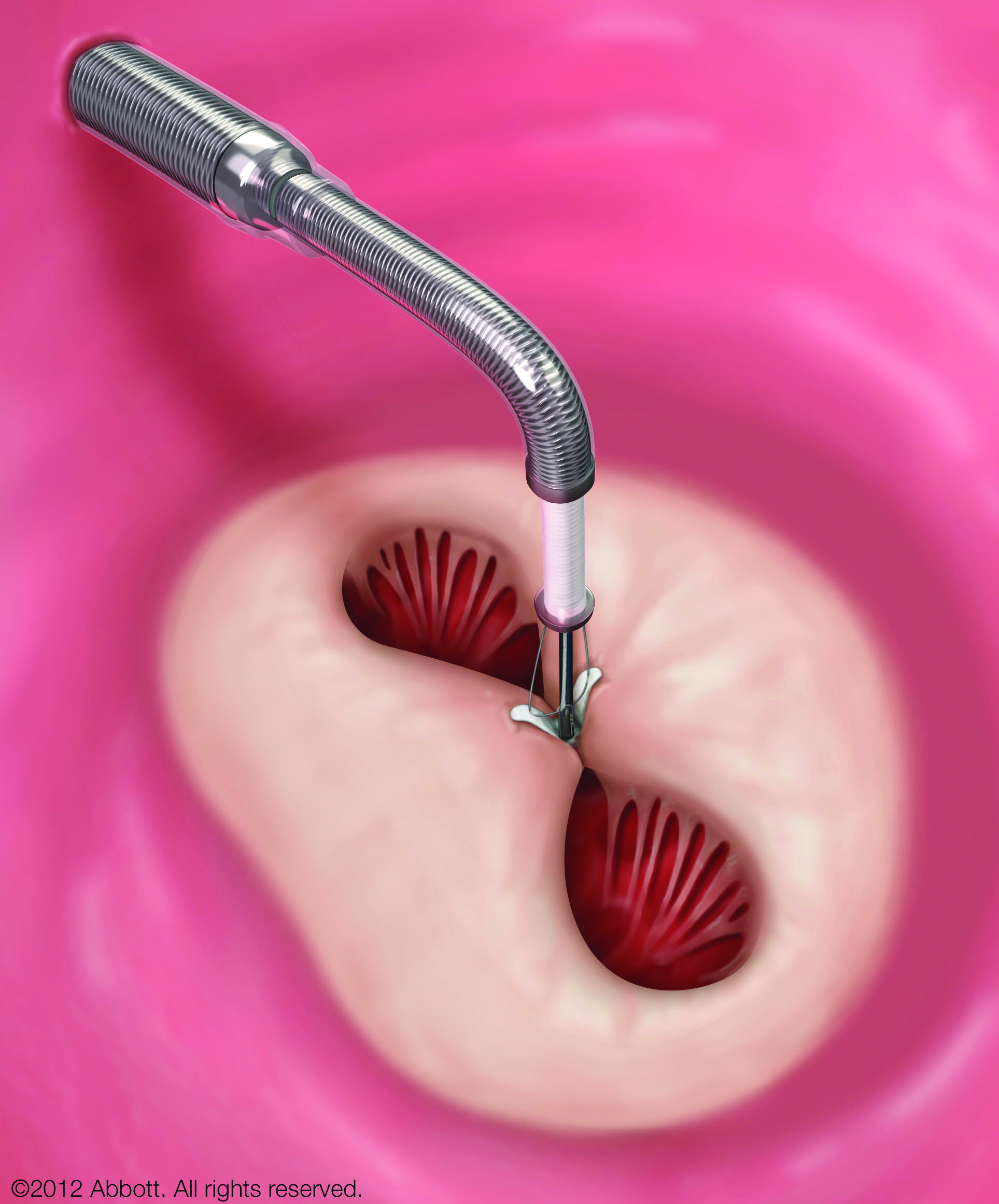 植え込み型ループレコーダー